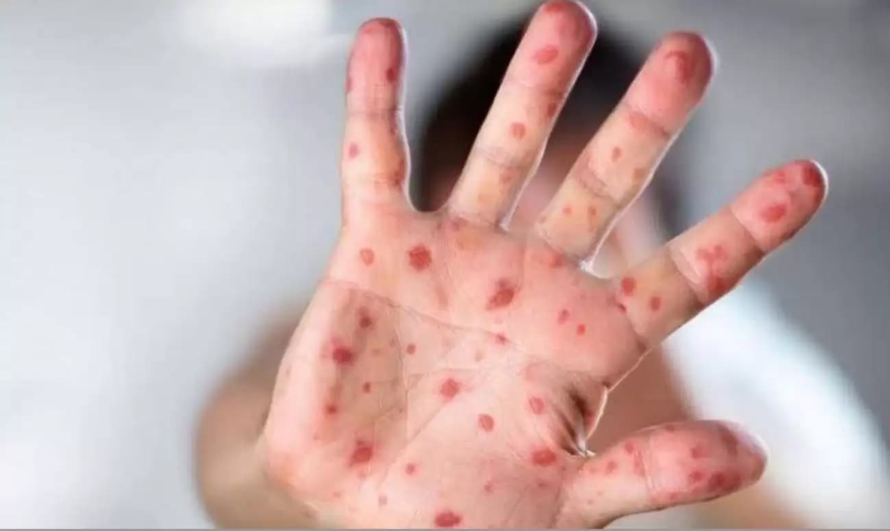 Hindari Virus Cacar Monyet, Dinkes Imbau PHBS di Masyarakat
