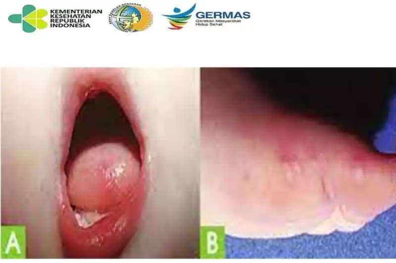 Gejala flu singapura pada anak