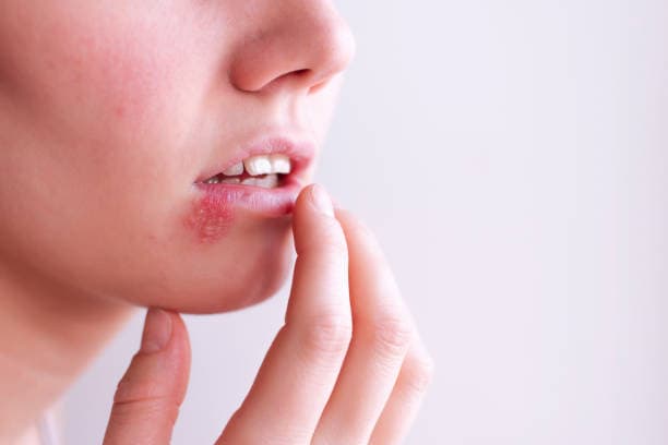 3 Penyebab Herpes Kulit Beserta Gejala dan Faktor Risikonya