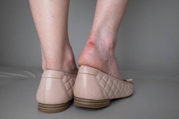 7 Cara Mengatasi dan Mencegah Kaki Lecet karena Sepatu