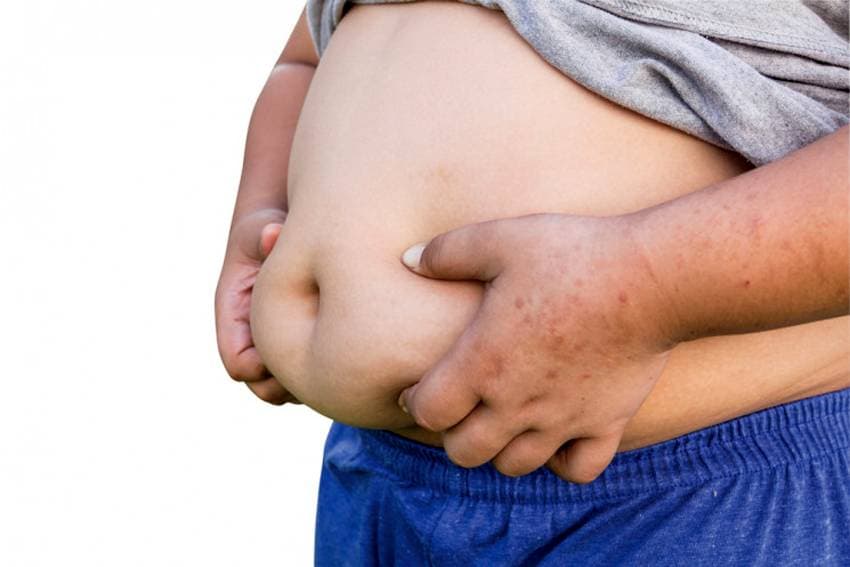 Ini Langkah yang Perlu Dilakukan untuk Mengatasi Obesitas
