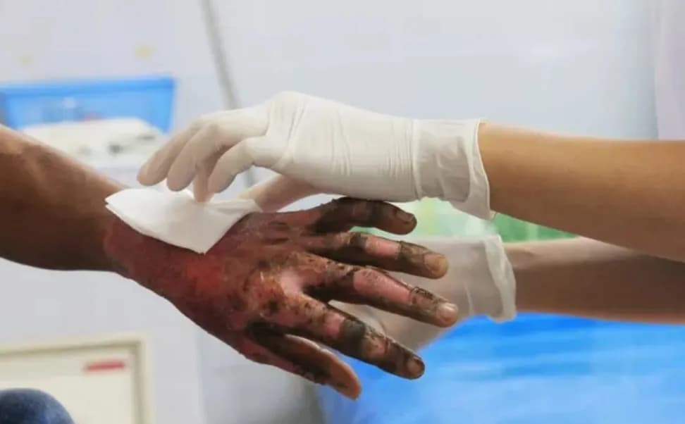 Dua Santri Korban Pembakaran di Ponpes Lombok Masih Berjuang Sembuh, Terkendala Tagihan