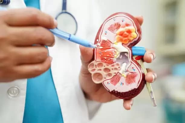 Jaga Kesehantan Ginjal, Ini Makanan yang Harus Dihindari