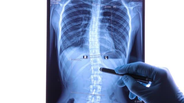 Ini Olahraga yang Aman untuk Penderita Skoliosis