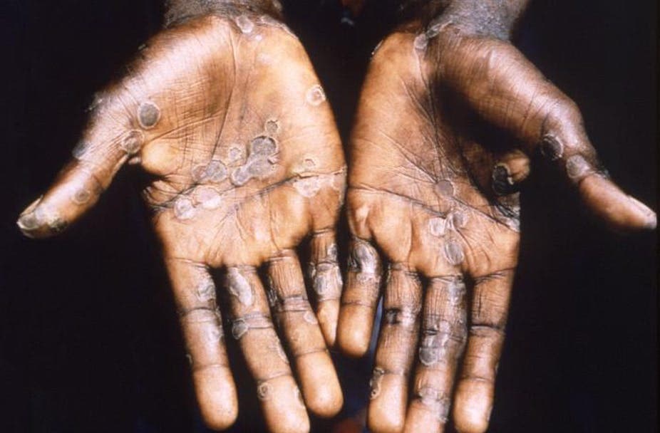 Waspada Monkeypox! Berikut Gejala, Penularan dan Cara Mencegahnya