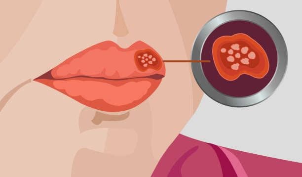 Penyakit Herpes? Berikut Gejala dan Cara Pengobatannya