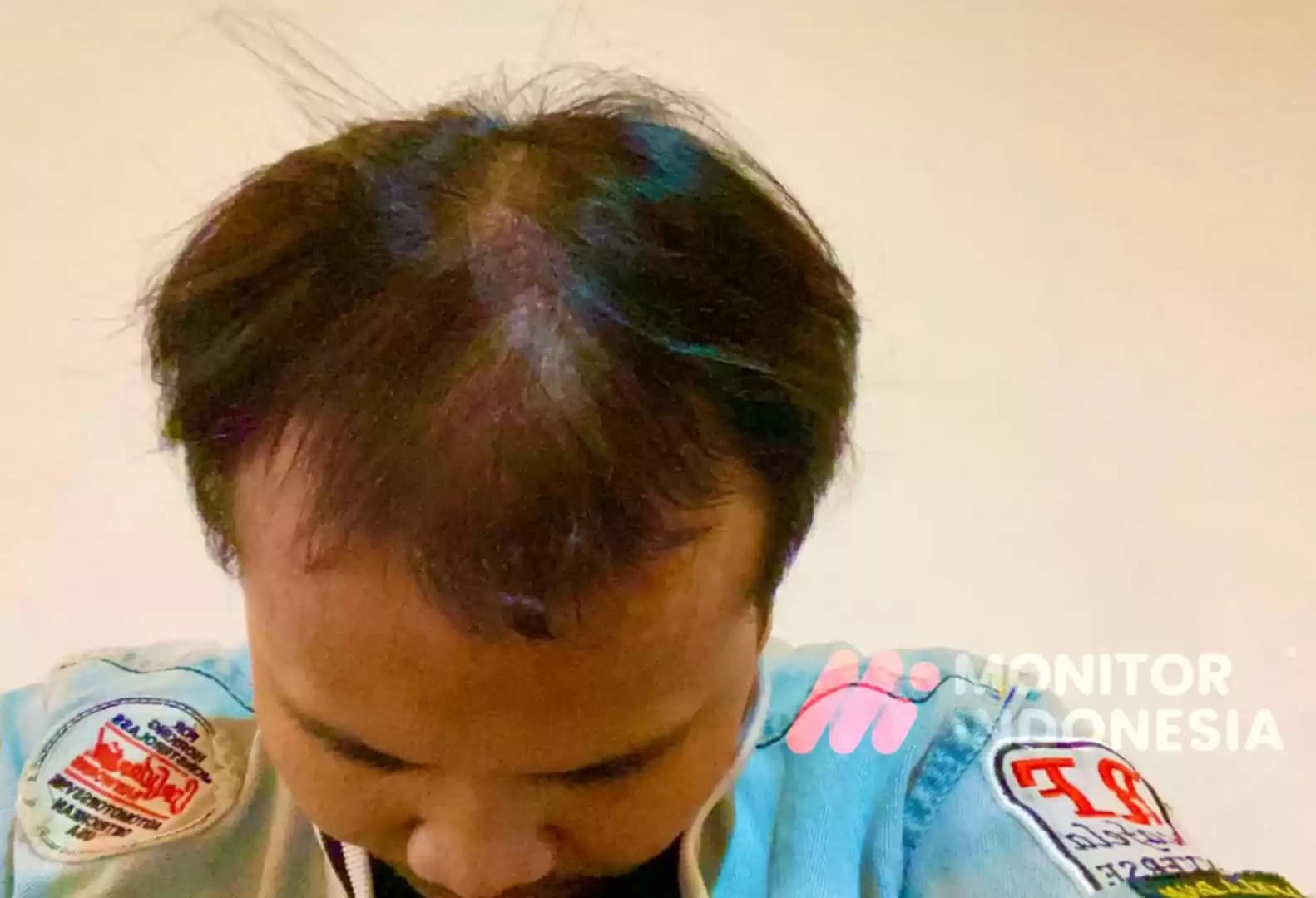 Foto Rambut Rontok