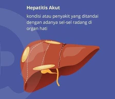 Diduga Hepatitis Akut, Anak 7 Tahun Meninggal di Tulungagung