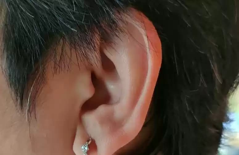 Ilustrasi - Tinnitus atau telinga berdenging