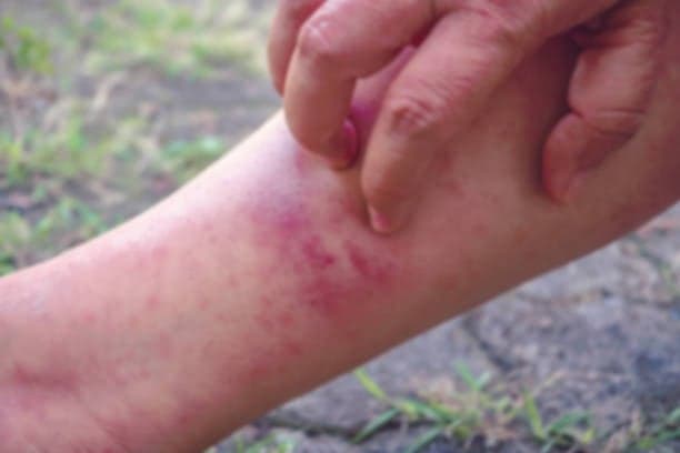 Kenali Jamur Ringworm, Berikut Gejala dan Cara Mengatasinya!