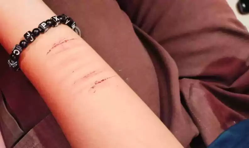Siswi sekolah dasar yang menjadi korban rudapaksa ayah kandungnya memperlihatkan bekas luka silet pada lengan. (Foto: Antara)
