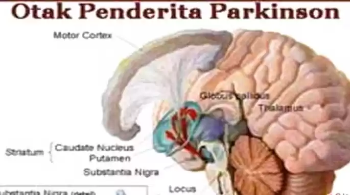Ilustrasi - Otak penderita penyakit parkinson. (Foto: Antara)