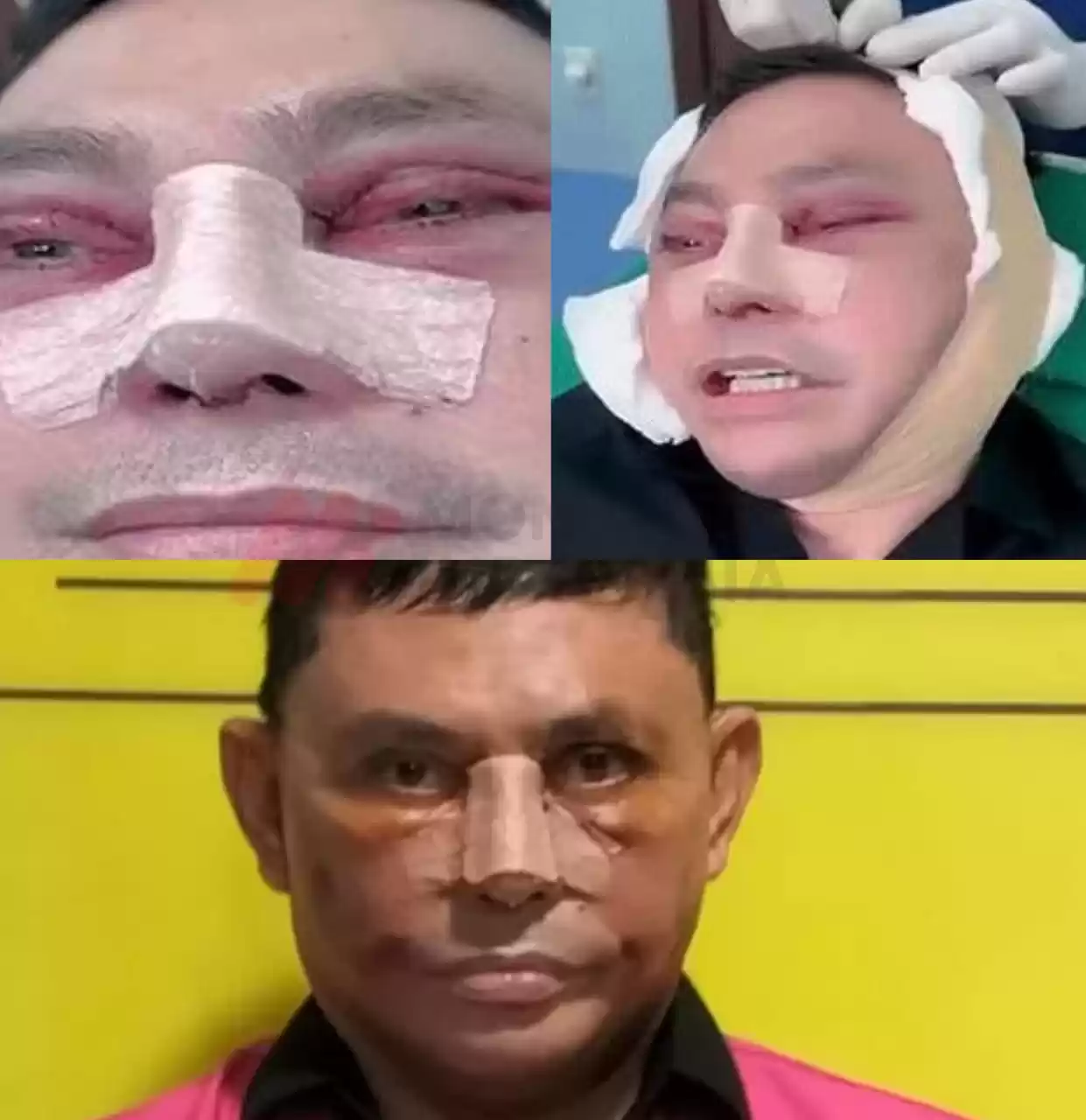 Sebelum ditangkap Kejaksaan Agung (Kejagung) beredar di Medsos, Ujang Iskandar melakukan operasi wajah di Vietnam (Foto: Kolase MI/Diolah dari berbagai sumber)